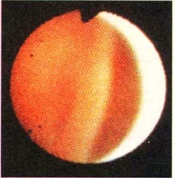 Правый желудочек сердца человека сфотографирован через сверхтонкий фиброскоп, введенный в плечевую артерию. Фиброскоп, диаметр которого меньше одного миллиметра, разработан в фирме Оlуmрus Corporation в Токио