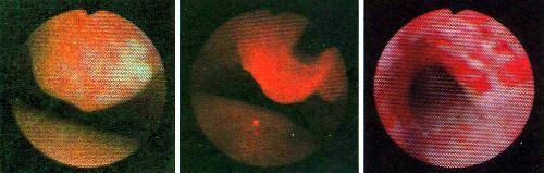 Фитодинамическая терапия позволяет удалить опухоль, закупорившую трахею (слева). Пациенту вводят краситель, который опухолью поглощается быстрее, чем здоровой тканью. Введенный в опухоль волоконный световод (в центре) подводит лазерное излучение, воздействующее на краситель. Через два дня, как видно на фотографии (справа), опухоль после облучения омертвилась, и теперь ее можно удалить